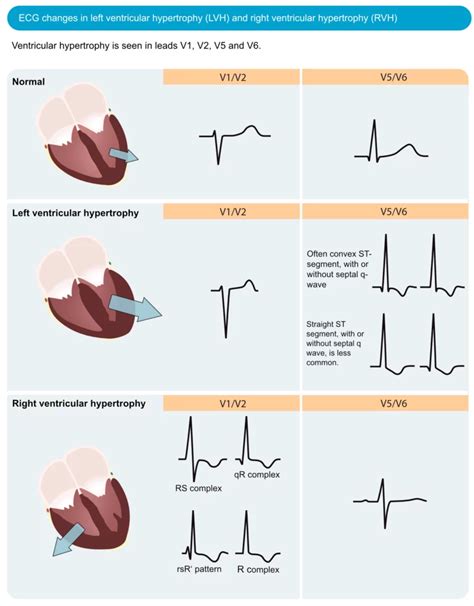 causes of lv hypertrophy|left ventricular hypertrophy on ecg.